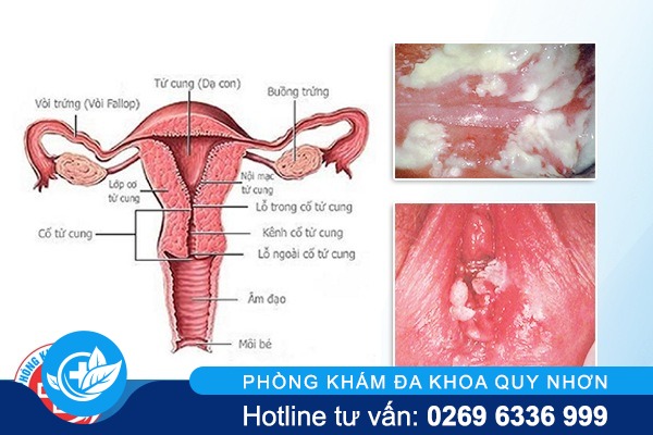 điều trị viêm phụ khoa tại Quy Nhơn Viêm phụ khoa