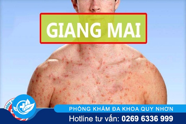 Hình ảnh bệnh giang mai một trong số những bệnh đường tình dục đáng sợ nhất