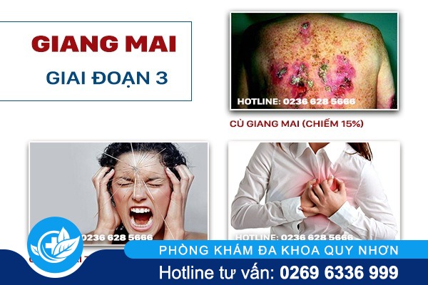 dieu-tri-benh-giang-mai-tai-da-nang