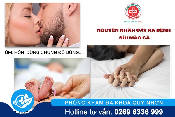 Sùi mào gà ở dương vật có thể gây vô sinh cho nam giới