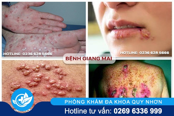dia-chi-xet-nghiem-benh-giang-mai