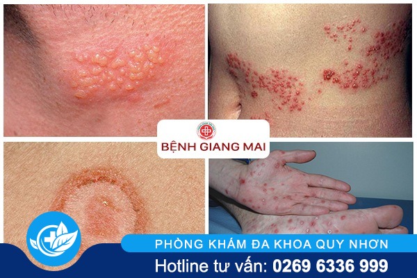 bệnh giang mai tại Quy Nhơn