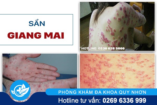 dieu-tri-benh-giang-mai-tai-da-nang