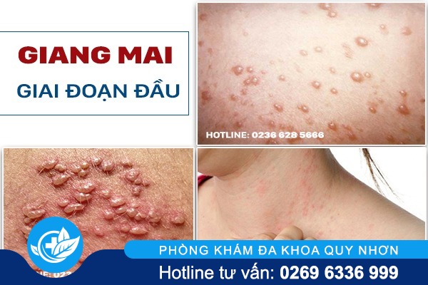 dieu-tri-benh-giang-mai-tai-da-nang