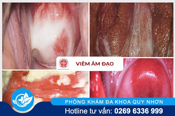 dieu-tri-viem-am-dao-tai-da-nang