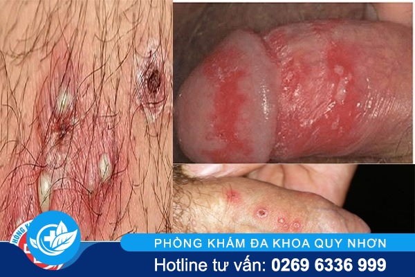 mun-rop-sinh-duc-nam