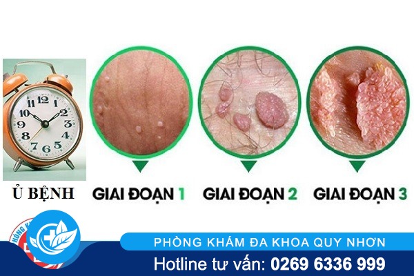 thoi-gian-phat-benh-sui-mao-ga