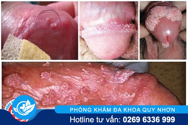 trieu-chung-sui-mao-ga-o-nam-gioi