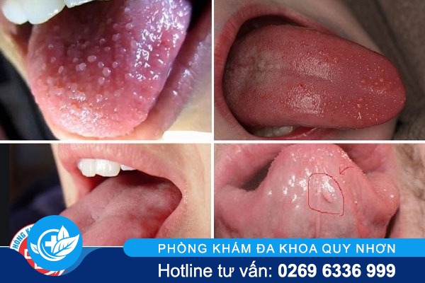 sui-mao-ga-o-luoi-giai-doan-dau-01