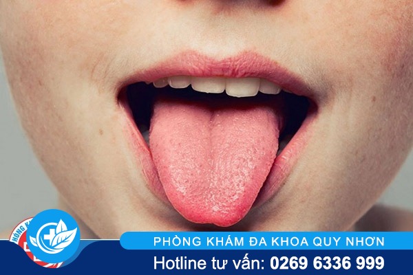 Bị nổi mụn ở lưỡi nghĩ ngay là sùi mào gà