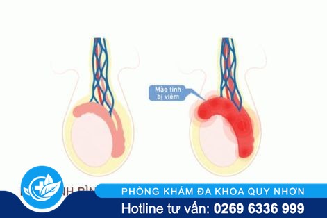 Viêm mào tinh hoàn là bệnh như thế nào?
