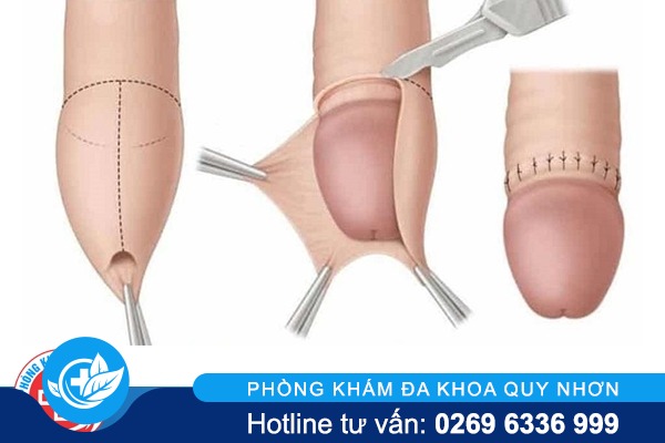 Ưu điểm cắt bao quy đầu công nghệ xâm lấn tối thiểu Hàn Quốc