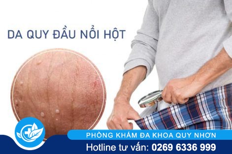 Da quy đầu nổi hột là bị bệnh gì?