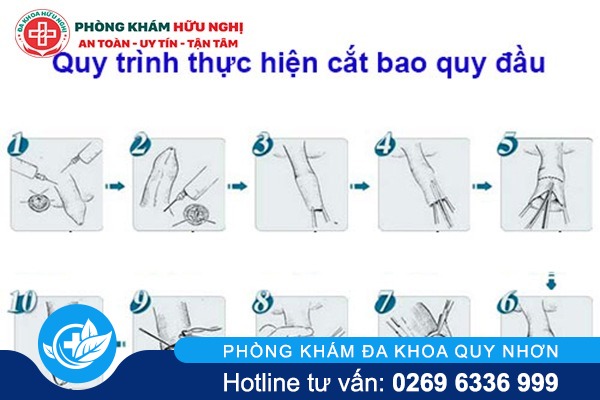 Quy trình cắt bao quy đầu 