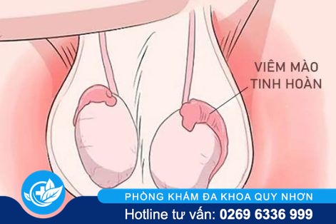 Hỗ trợ điều trị viêm mào tinh hoàn như thế nào hiệu quả?