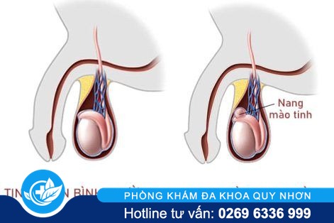 Tinh hoàn nổi cục là bị bệnh gì?