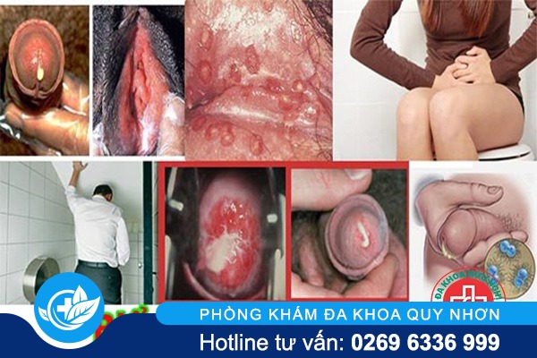 trieu-chung-benh-lau