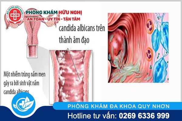 trieu-chung-cua-benh-viem-am-dao