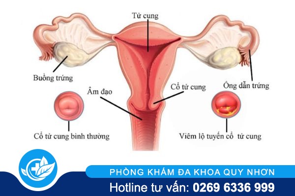 viem-lo-tuyen-co-tu-cung