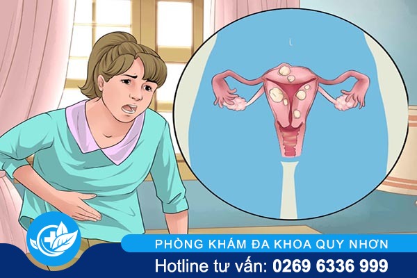 Trễ kinh là triệu chứng của bệnh gì?