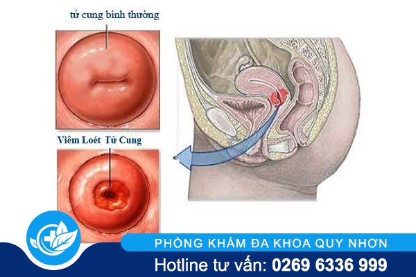 bieu-hien-viem-loet-tu-cung