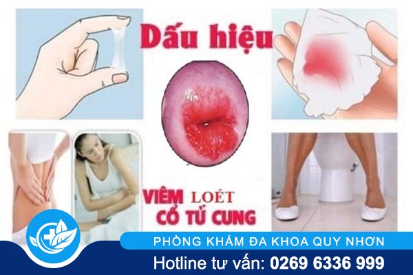 dau-hieu-viem-loet-co-tu-cung-va-cach-dieu-tri-hieu-qua-02