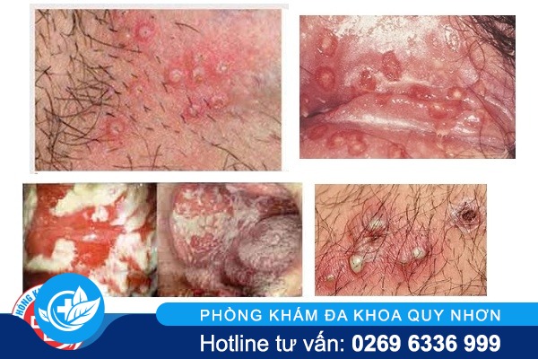 ngua-vung-kin-nu-nguyen-nhan