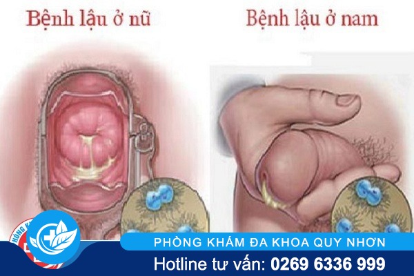 benh-lau-co-chua-khoi-han-duoc-khong