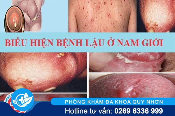 benh-lau-o-nam-gioi