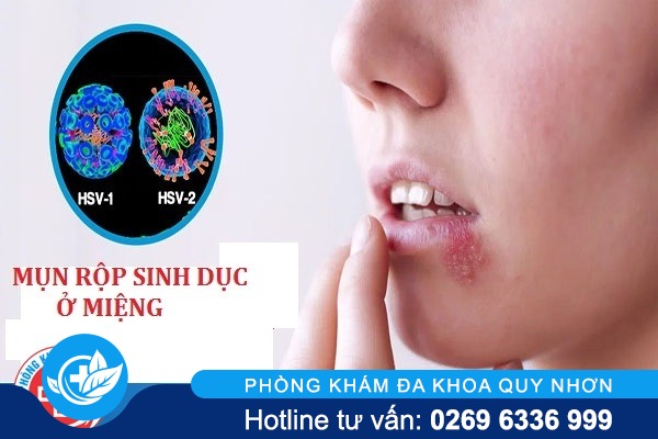 Mụn rộp sinh dục ở miệng có dấu hiệu như thế nào?