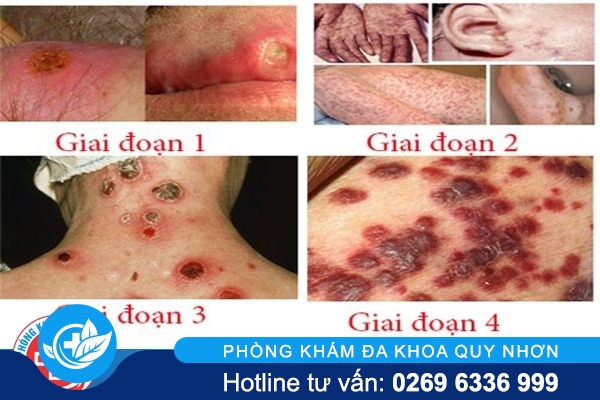 hinh-anh-giang-mai-qua-các-giai-doan