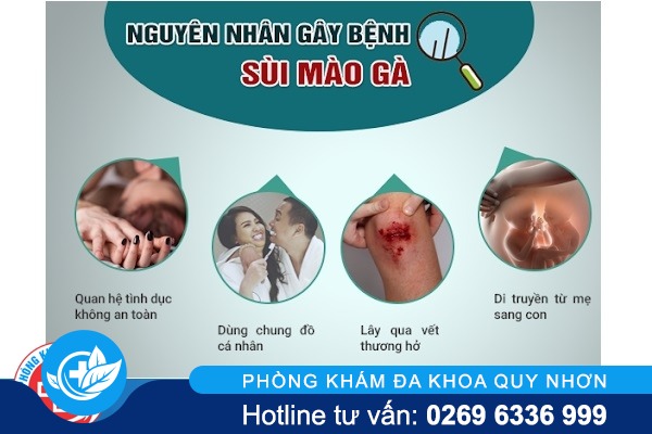 Nguyên nhân gây bệnh sùi mào gà