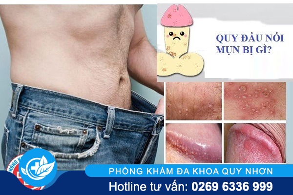 quy-dau-noi-mun