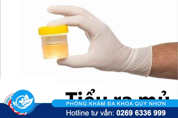 Cách chữa tiểu ra mủ như thế nào?