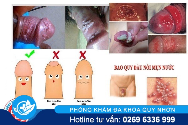 benh-bao-quy-dau