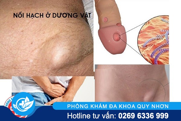 Dương vật nổi hạch là bệnh gì cách điều trị hiệu quả