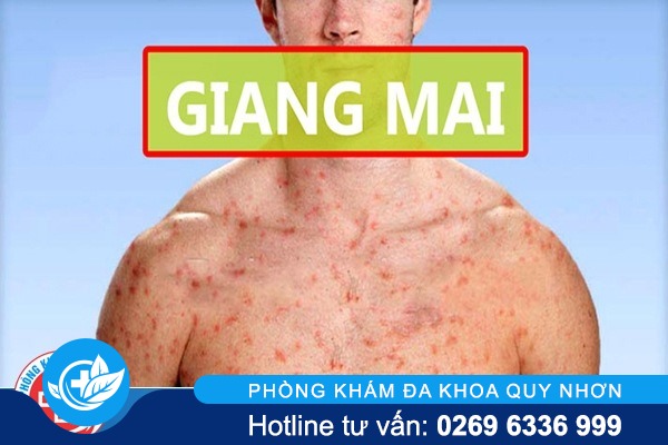 Giang mai xuất hiện ở những nơi đâu trên cơ thể?