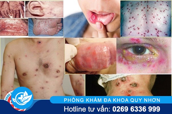 hinh-anh-benh-giang-mai-o-nam-gioi-e1574502902536