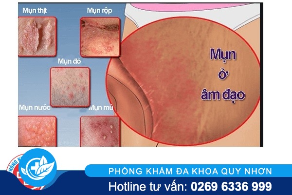 Âm đạo chảy mủ do lậu