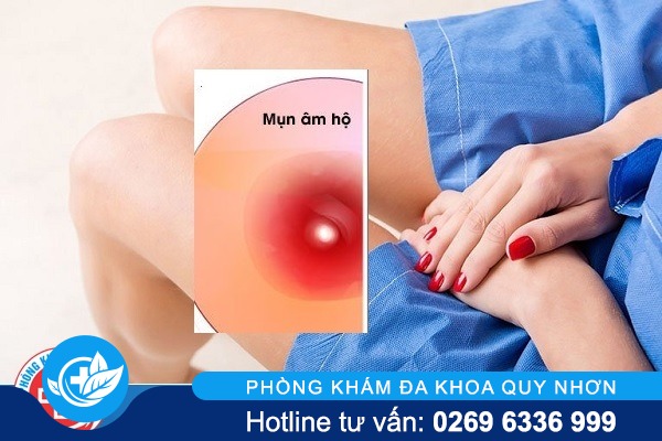 Nổi mụn ở âm đạo âm vật vùng kín nữ là bị bệnh gì?