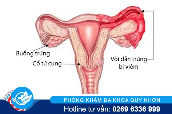 Viêm ống dẫn trứng là bệnh gì chữa được không?