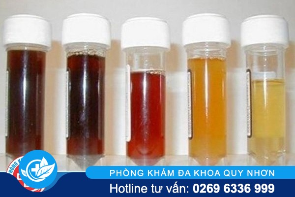 Màu sắc nước tiểu nói lên bệnh gì?