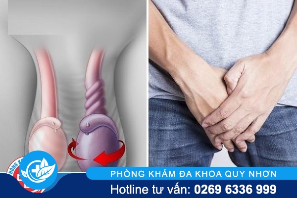 Xoắn tinh hoàn dấu hiệu nhận biết và cách điều trị hiệu quả