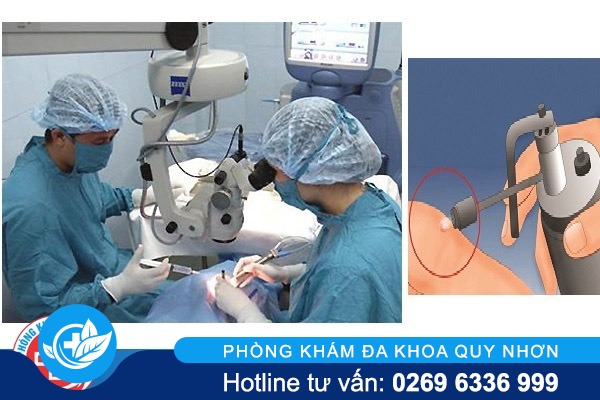 Đốt gai sinh dục có hiệu quả không chi phí bao nhiêu?