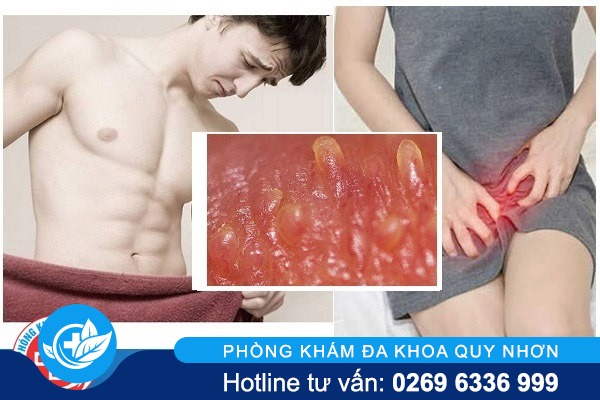 Cách nhận biết và điều trị u nhú sinh dục hiệu quả