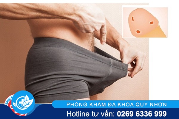 Nổi mẩn đỏ ở vùng kín nam phải làm sao?