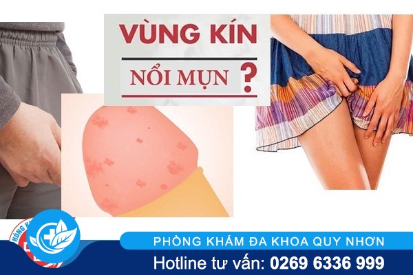 Bộ phận sinh dục nổi hạt li ti phải làm sao?