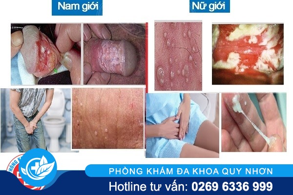 dau-hieu-viem-nhiem-o-bo-phan-sinh-duc