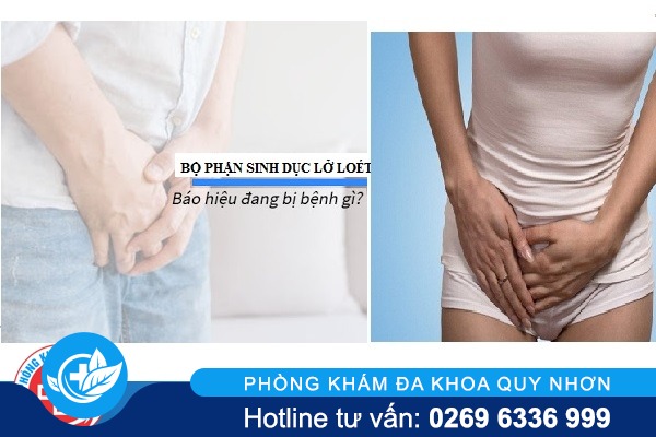 Lở loét bộ phận sinh dục biểu hiện bệnh gì cách trị
