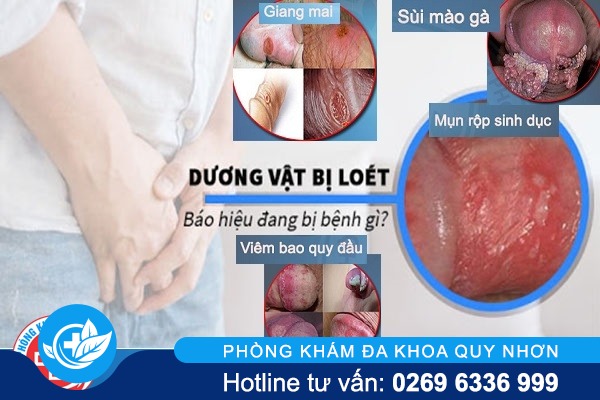 lo-loet-duong-vat-benh-gi